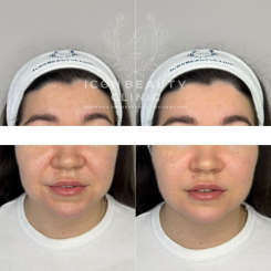 Биоревитализация Новакутан Био Про